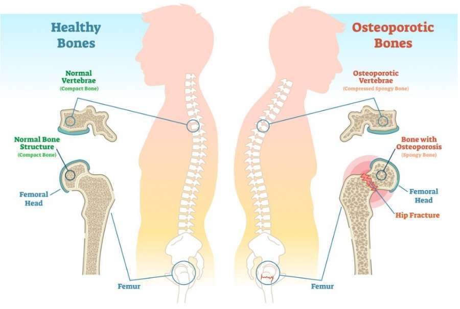 osteoartritis i njegov forum liječenje bol ispod rebara i bolovi u zglobovima