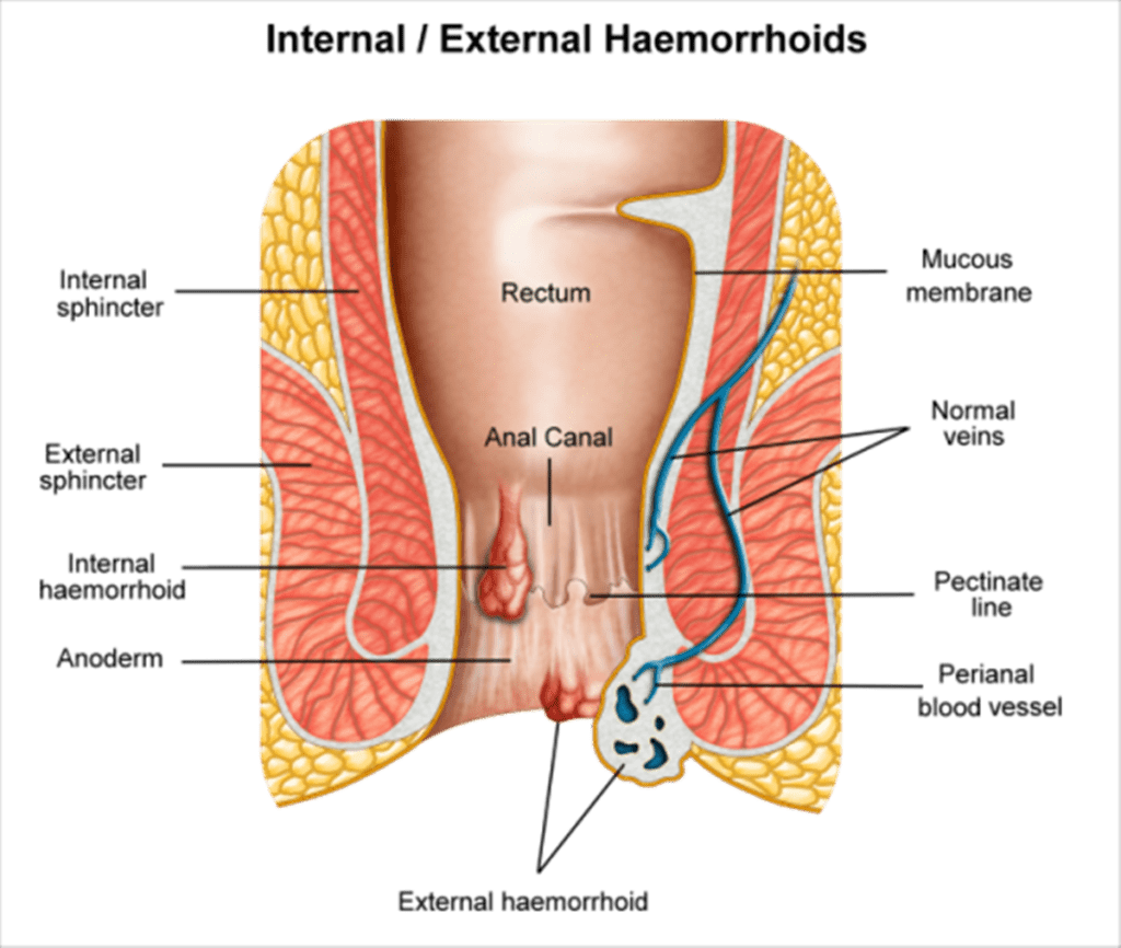 Co powoduje hemoroidy?